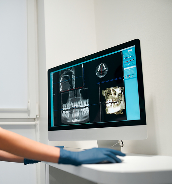 Dentist looking at x-rays of a patient's teeth and jaws on a computer monitor