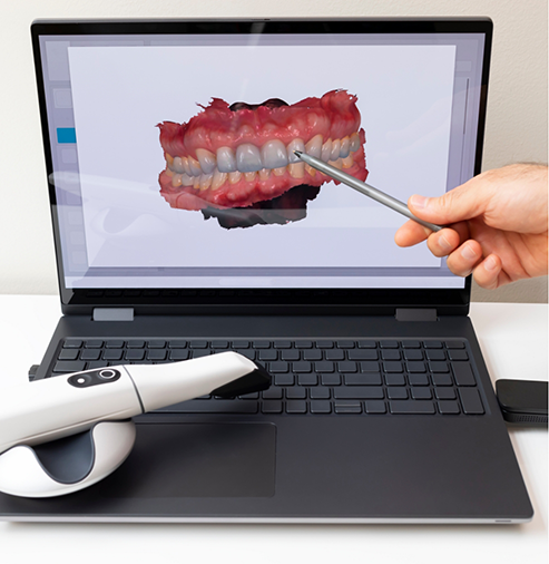 Computer monitor showing a digital impression of a patient's teeth