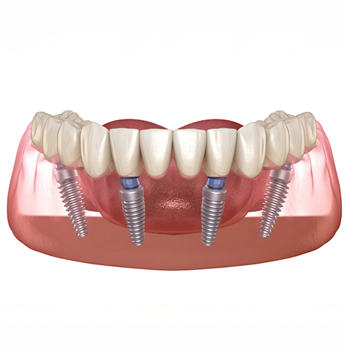 Illustration of an All-on-4 implant denture on the lower arch