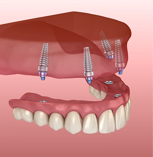 Illustration of All-on-4 on the upper arch