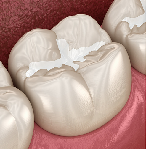 Illustration of a tooth with a white filling