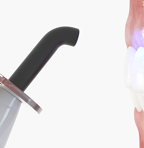 Illustration of an ultraviolet light being applied to a tooth