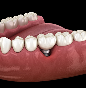 Illustration of a dental implant with a crown on top