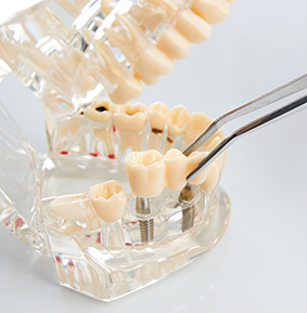 Dental bridge being placed onto a model of dental implants