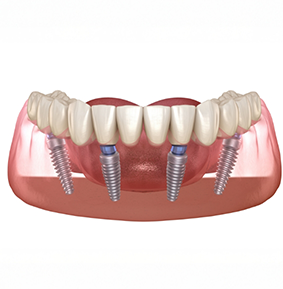 Illustration of All-on-4 dental implants