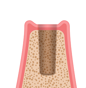 Illustration of a jawbone where a tooth is missing