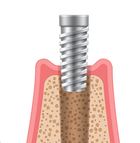 Illustration of a dental implant being placed in the lower jaw