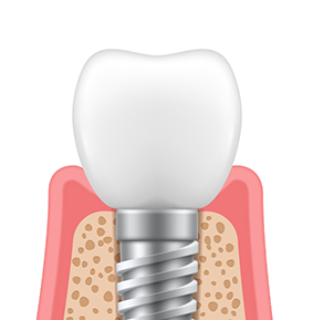 Illustration of a crown on top of a dental implant