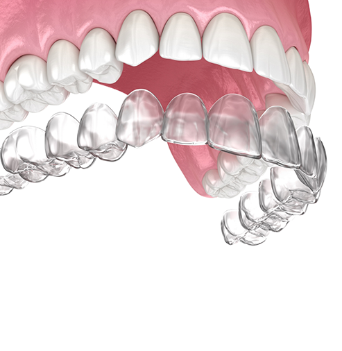 Illustration of an Invisalign aligner being placed over the teeth