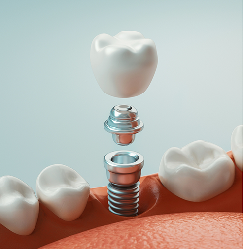 Illustration of a dental implant and crown replacing a missing tooth