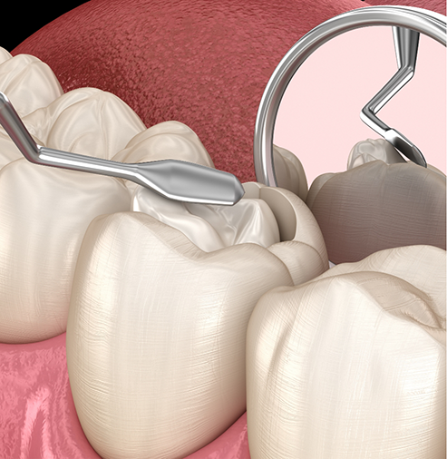 Illustration of a white filling being placed in a tooth