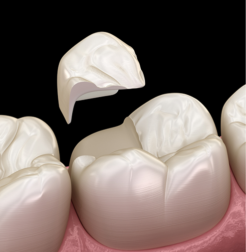 Illustration of a dental onlay being placed to restore a broken tooth