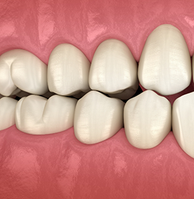 Illustration of crowded and misaligned teeth