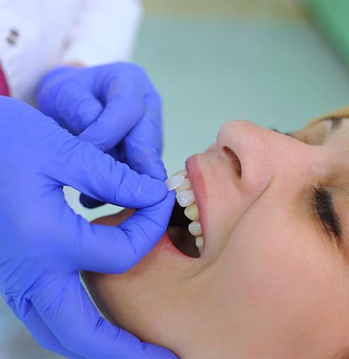 Dentist placing a veneer over a tooth