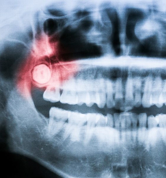 X-ray of a mouth with an impacted wisdom tooth