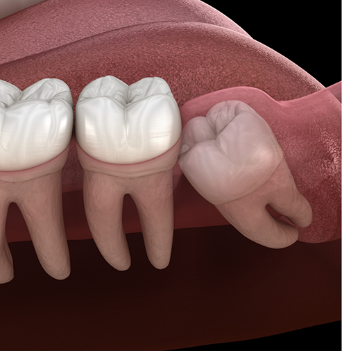 Illustration of an impacted wisdom tooth