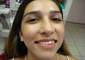 Dentist Alexandria VA Invisalign Before Smile