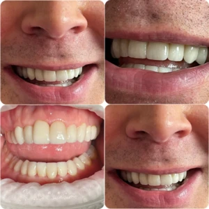 Dentist Alexandria VA Advantages of Ultra Think Veneers