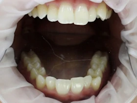 Dentist Alexandria VA Case 15 Before Invisalign