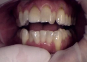 Dentist Alexandria VA Case 30 Before Invisalign