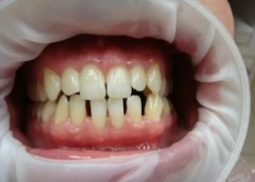 Dentist Alexandria VA Case Study 15 Before