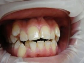 Dentist Alexandria VA Case Study 16 Before