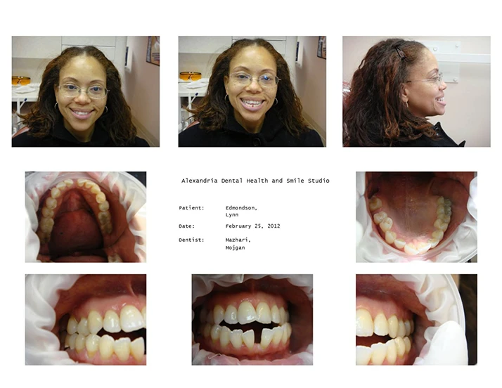 Dentist Alexandria VA Case Study 20