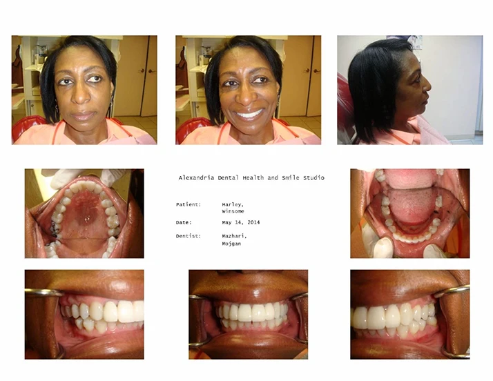 Dentist Alexandria VA Case Study 21 After