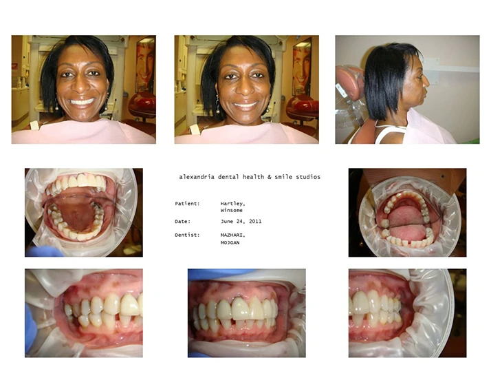 Dentist Alexandria VA Case Study 21 Before