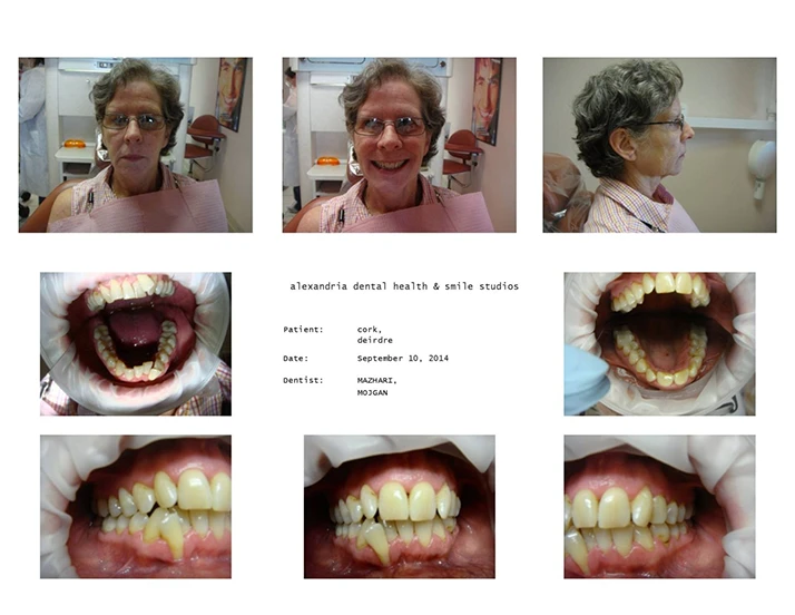 Dentist Alexandria VA Case Study 22 Before