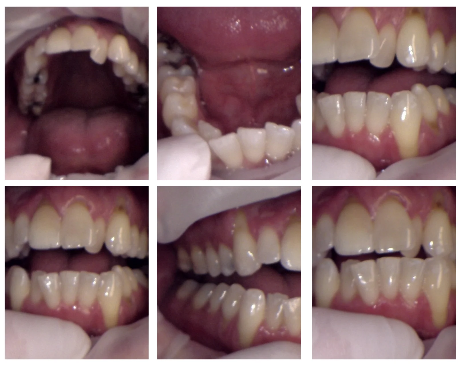 Dentist Alexandria VA Case Study 30 Before