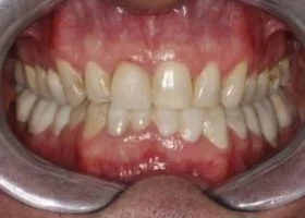 Dentist Alexandria VA Case Study 34 Before