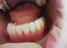 Dentist Alexandria VA Case Study 47 After Bottom