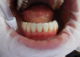 Dentist Alexandria VA Case Study 47 After Jaw