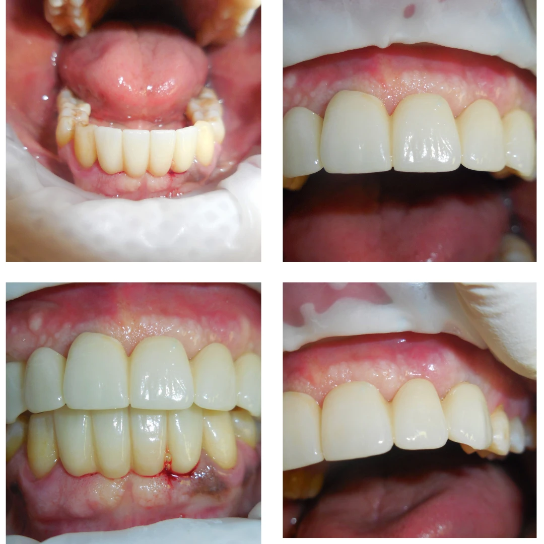 Dentist Alexandria VA Case Study 5 Implant Supported Bridges