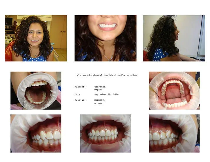 Dentist Alexandria VA Case Study 8 After