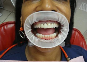 Dentist Alexandria VA Case Study Before Full Mouth